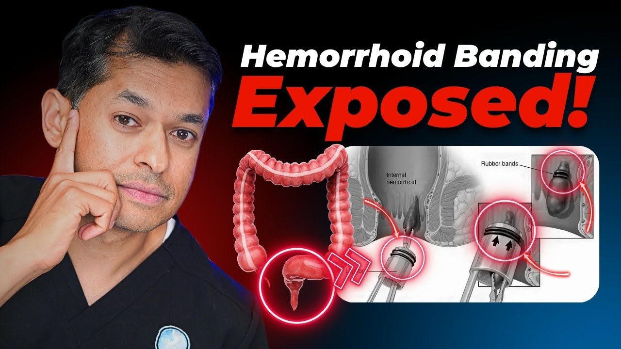 No More Hemorrhoids! Here’s How Banding Works Step by Step